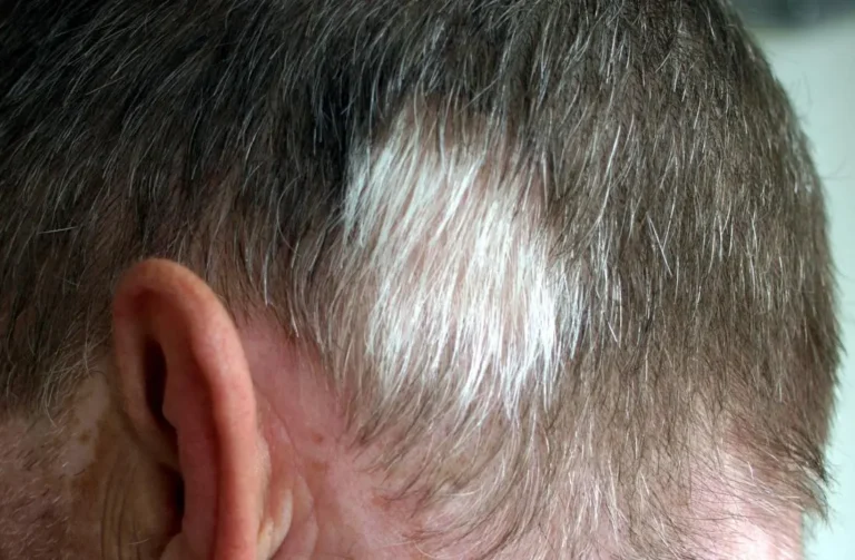 WHAT CAUSES RANDOM LONG WHITE BODY HAIRS?